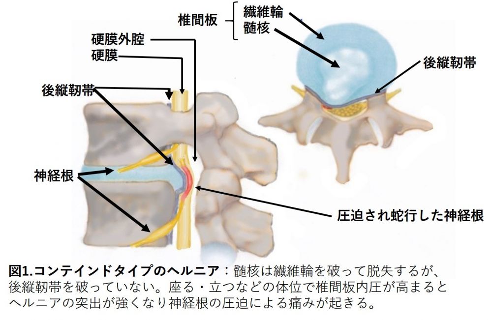 コンテインドタイプのヘルニア
