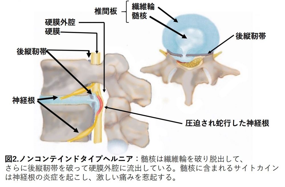 ノンコンテインドタイプのヘルニア
