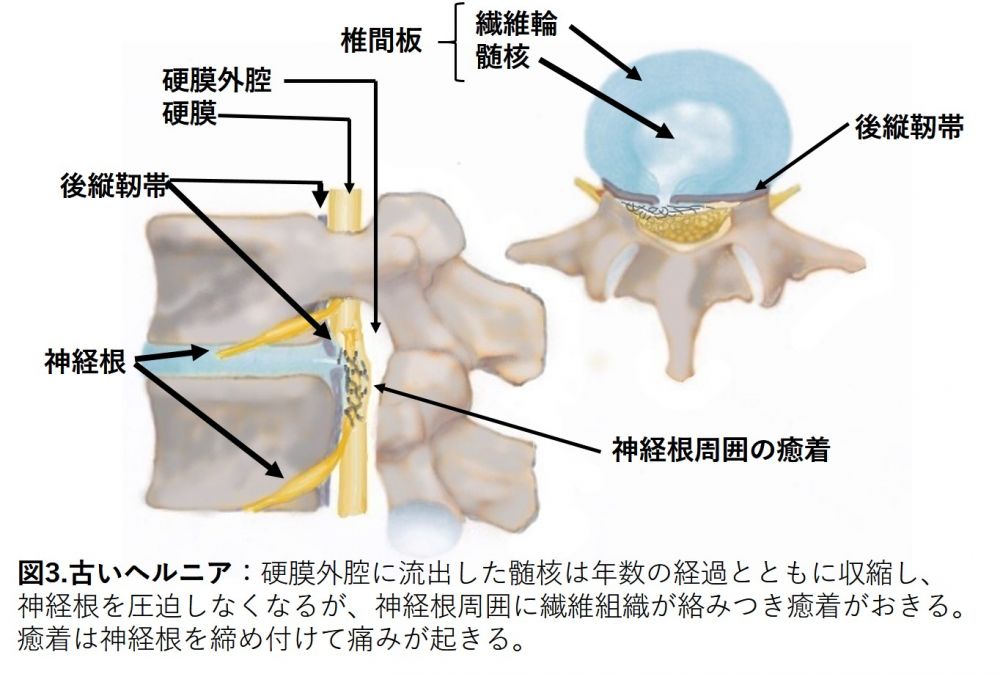 慢性化したヘルニア
